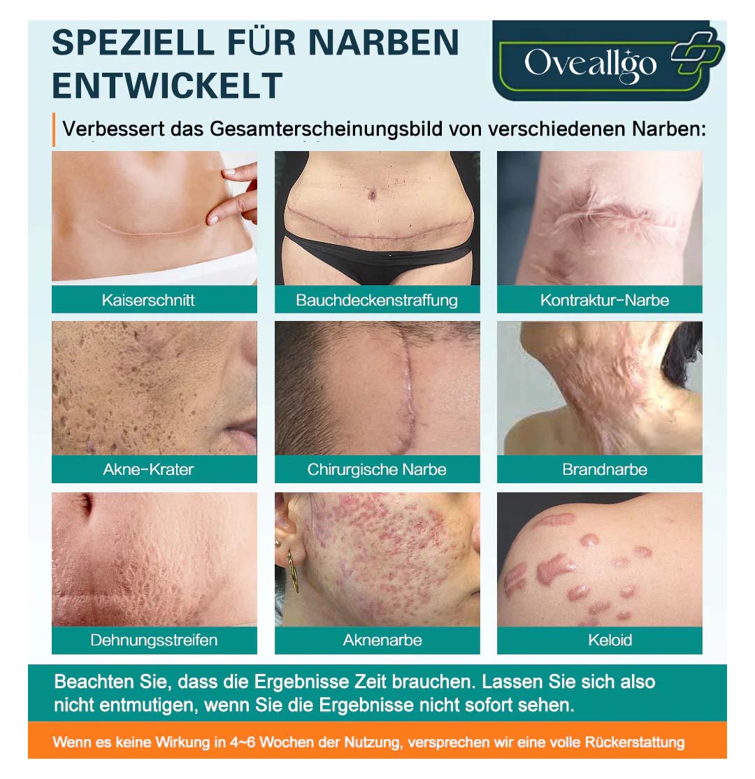 Oveallgo™ Fortgeschrittenes Spray zur Narbenentfernung