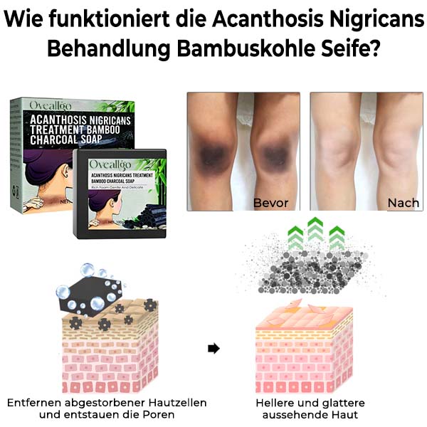 Oveallgo™ Acanthosis Nigricans Behandlung Seife aus Bambuskohle