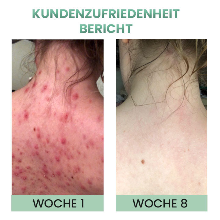 DerMist Rücken Akne Behandlung Kräuterspray