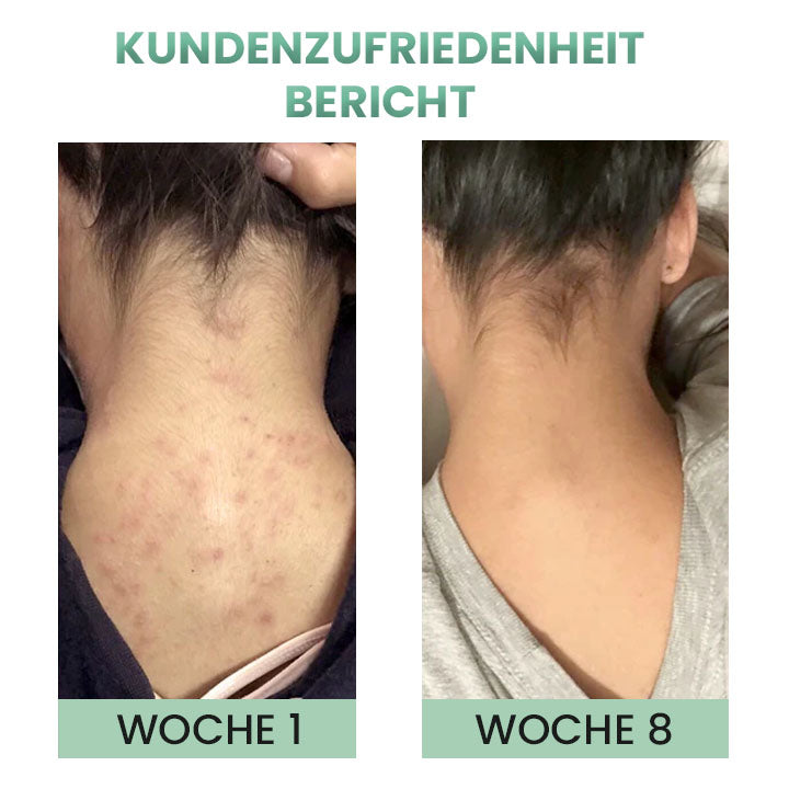 DerMist Rücken Akne Behandlung Kräuterspray