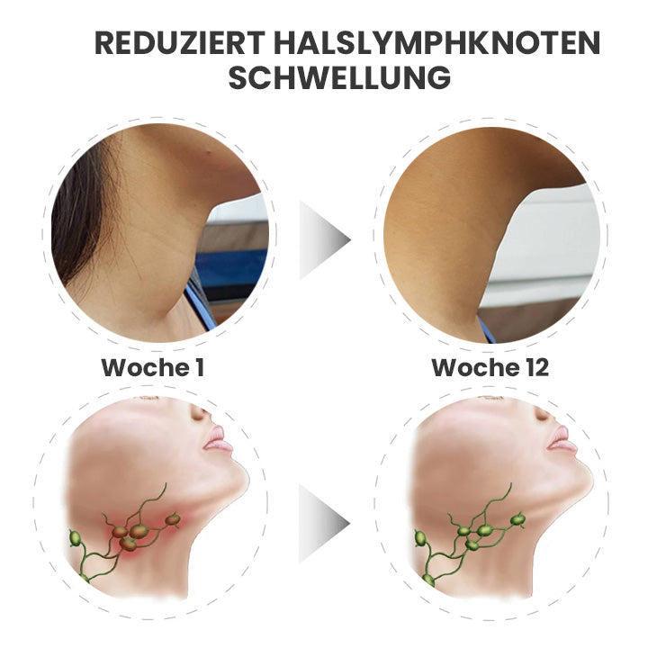 GooLivingUltra Anti-Höcker Lymphpflege Ingwer Salbe