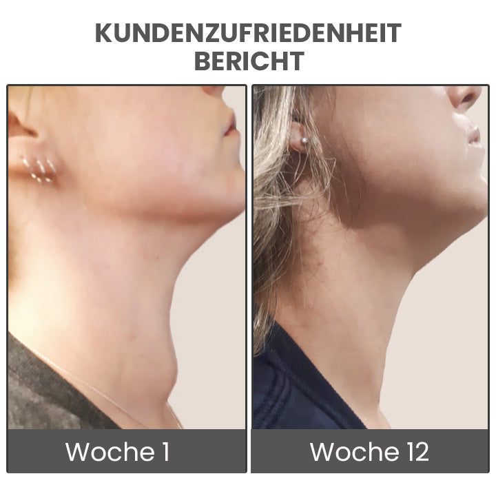 GooLivingUltra Anti-Höcker Lymphpflege Ingwer Salbe