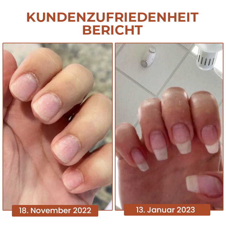 Oveallgo™ 7 Tage Profi Maximale Stärke Nagel-Reparatur-Serum