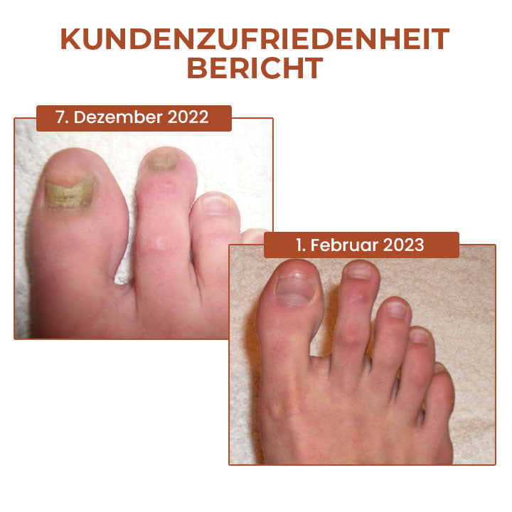 Oveallgo™ 7 Tage PURI Maximale Stärke Nagel-Reparatur-Serum