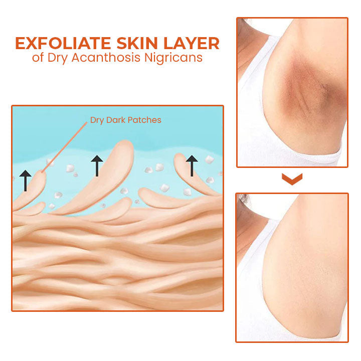 Oveallgo™ Akanthose LUX Nigricans Therapieöl