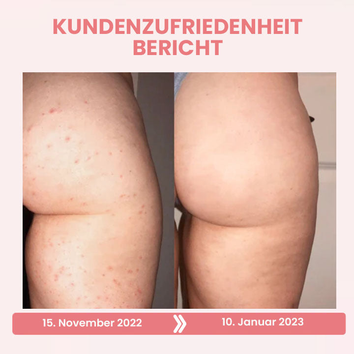 Oveallgo™ BootyBoost AntiAkne Peeling Natürliche Seife