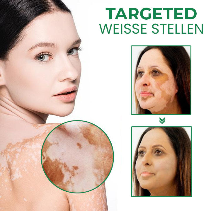 Oveallgo™ VitiligoFix X Revitalisierendes Elixier