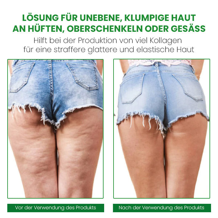 SusoSkin Profi 2-in-1-Kräuterbalsam zur Beruhigung von Cellulite