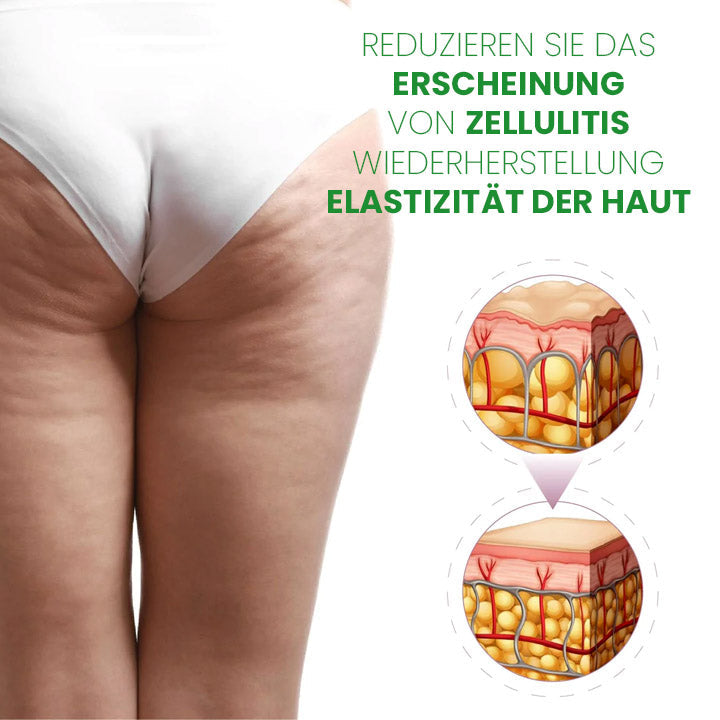 SusoSkin Profi 2-in-1-Kräuterbalsam zur Beruhigung von Cellulite