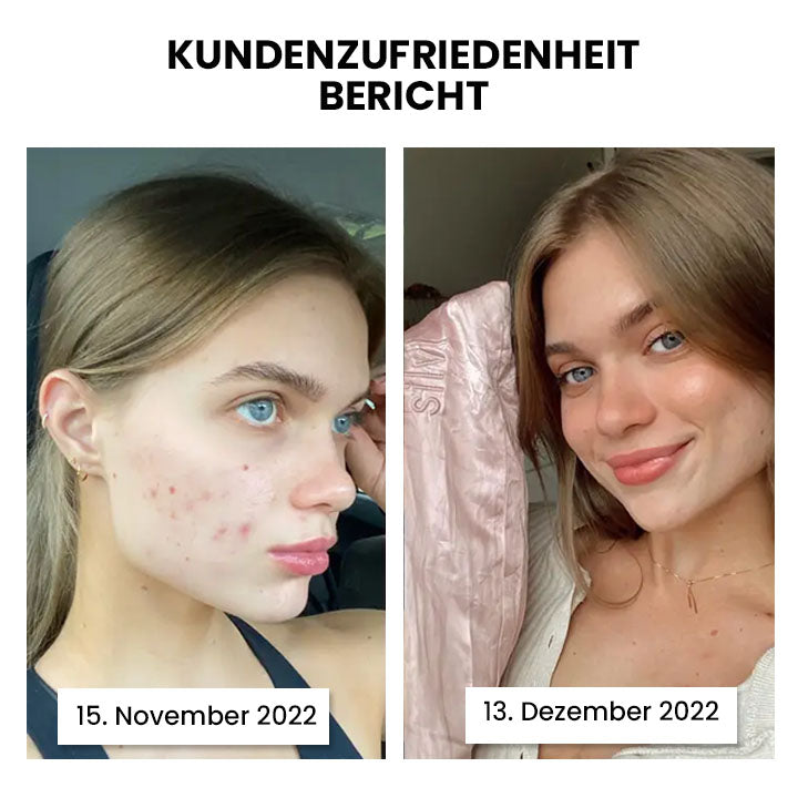 Thiccfitts™ Luxe Silk Anti-Acne Kopfkissenbezug