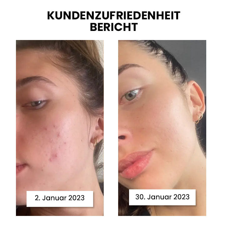 Thiccfitts™ Luxe Wunder Silk Anti-Acne Kopfkissenbezug