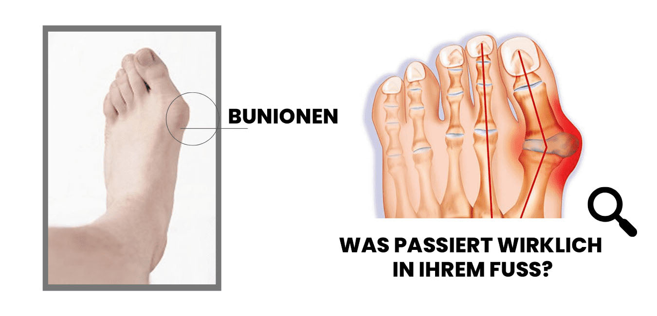 Wingle Profi Anti-Bunions Gesundheitssocke