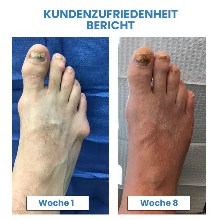 Wingle Profi Anti-Bunions Gesundheitssocke